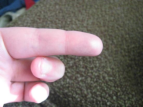 Slylo dito sulla mano: cause, trattamento e prevenzione